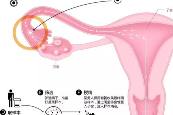 单身女性人工授精（普通人千万不要尝试）.