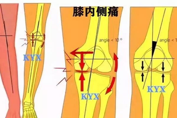 男16岁摔倒后左膝关节逐渐肿大关节腔抽出血性积液.