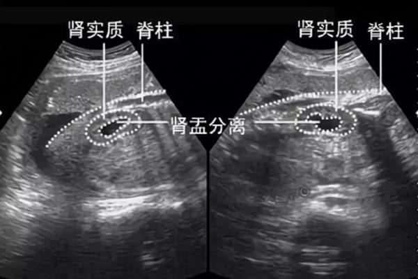 b超单有这个一般是男孩（有科学依据吗）.