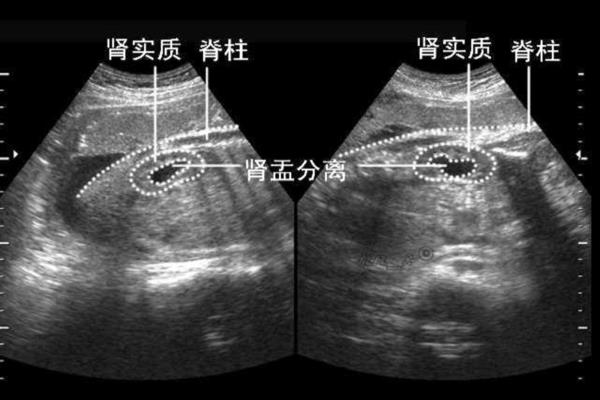 肾盂分离就是男孩吗但是b超说是女孩该相信哪个.