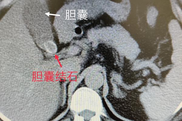 女性右上腹部隐痛的原因有哪些女性右上腹每天下午隐痛.